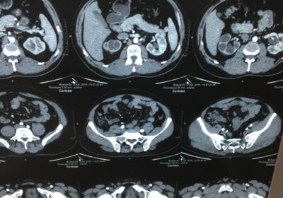 Резекція нирки (парціальна нефректомія partial nephrectomy, видалення пухлини нирки) нефректомія