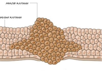 Що таке  рак?