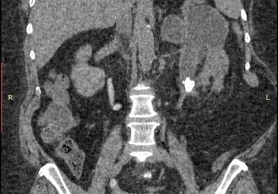 Сечокам’яна хвороба (СКХ) Urolithiasis
