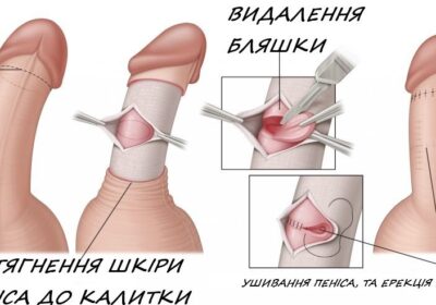 Хірургічні втручання при викривленні статевого члена (Процедури вкорочення пеніса)