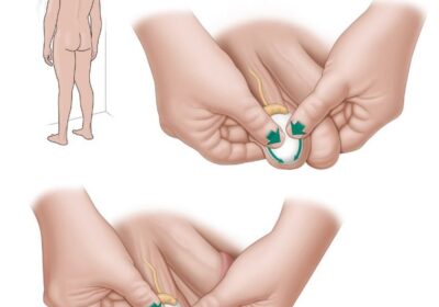 Рак яєчка (семінома) Testicular Cancer