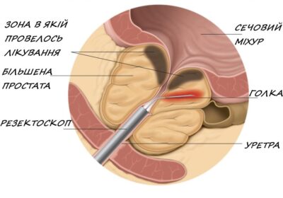Трансуретральна мікрохвильова терапія передміхурової залози