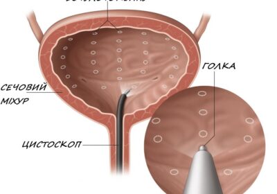 Ін’єкція ботулотоксину в сечовий міхур