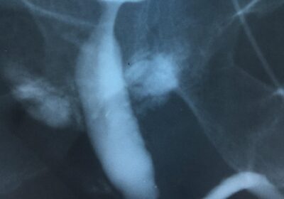 Стріктура уретри (urethral stricture)