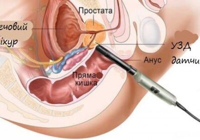 Біопсія передміхурової залози (простати)